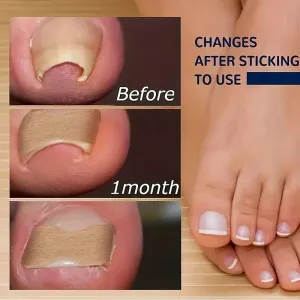 Fix Toenail Problems with 50 Nonadhesive Treatment Patches